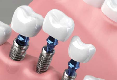 How the U.S. Dental Implant Market is Shaping the Future of Oral Health 