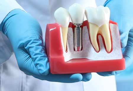 Dental Implants: Technological Advances and Cost Dynamics in 2025
