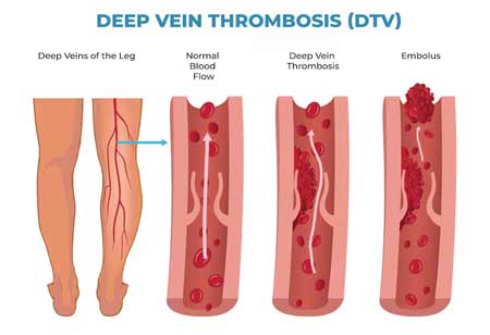 What are the Most Common Types of Vascular Diseases? 